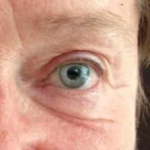 Ptosis - nachher
