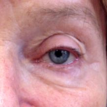 Ptosis - vorher
