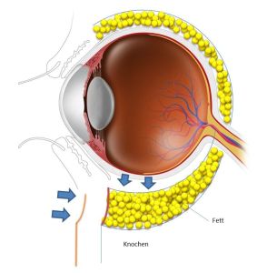 eingefallene Augen nach Tränensack Entfernung