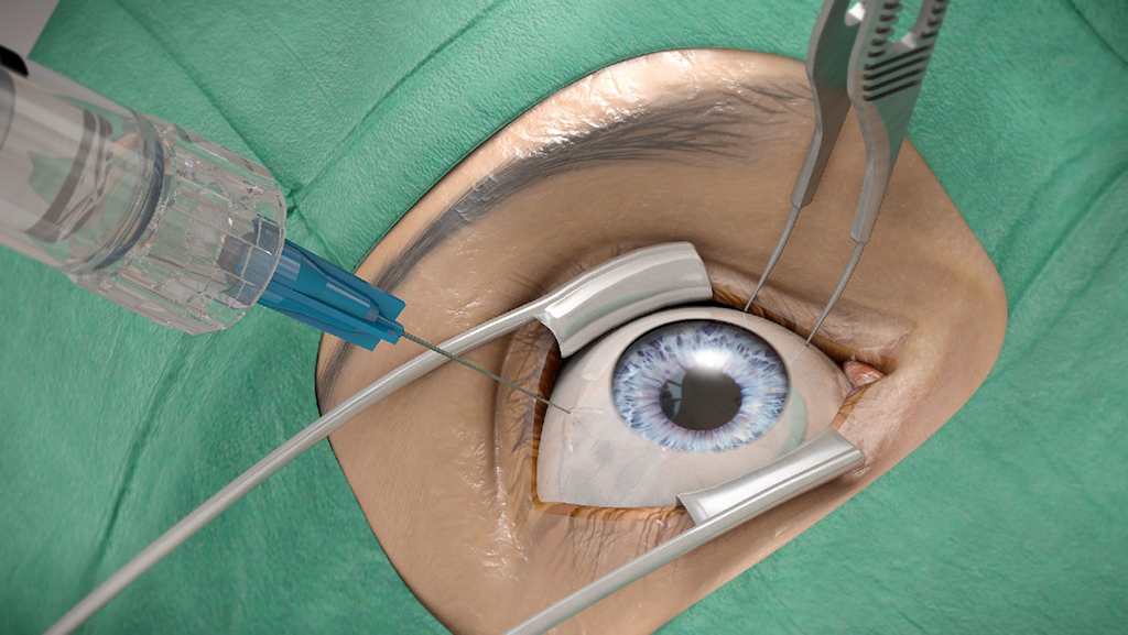 Intravitreale Injektion im Bereich der Pars plana 1