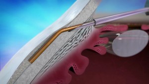 XEN Implantat (Fa. Polytech-Domilens)